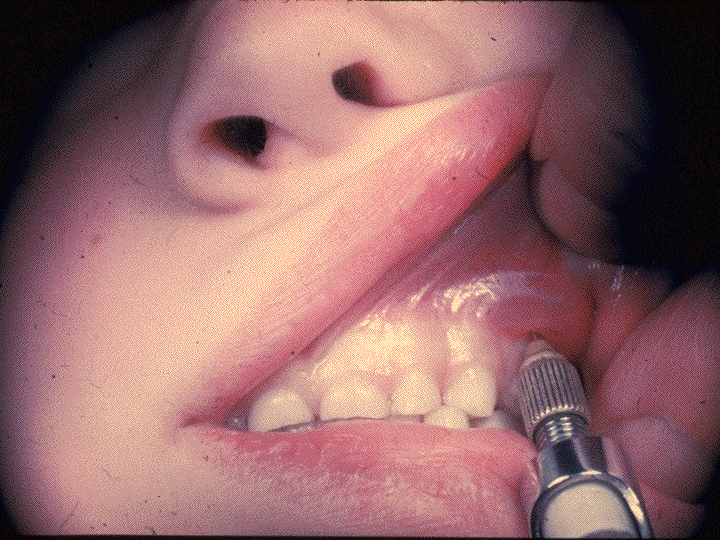 PowerPoint Presentation Local Anesthesia for the Pediatric Patient