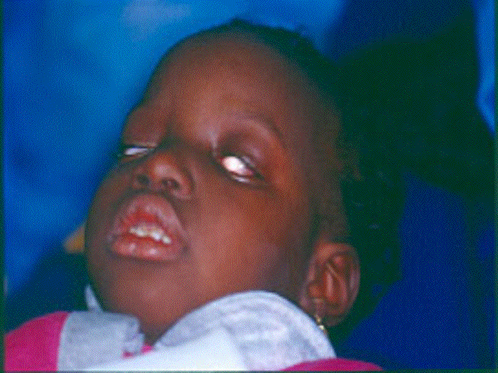 PowerPoint Presentation Local Anesthesia for the Pediatric Patient