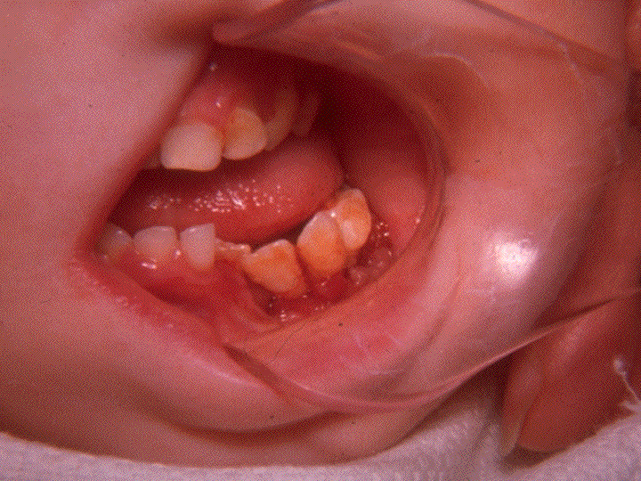 PowerPoint Presentation Pediatric Oral Pathology