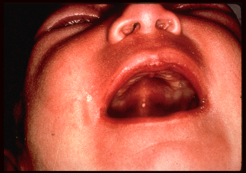 PowerPoint Presentation Pediatric Oral Pathology