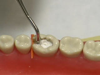 Tooth cement cheap