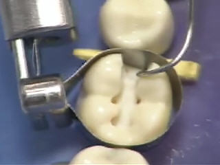 class ii amalgam