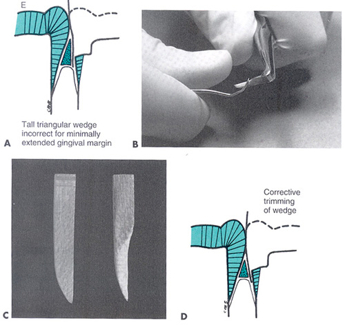 class ii amalgam