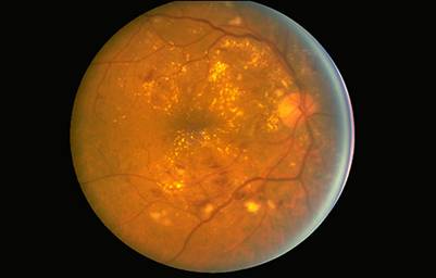 Non-proliferative diabetic retinopathy
