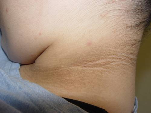 NECK: acanthosis nigricans 