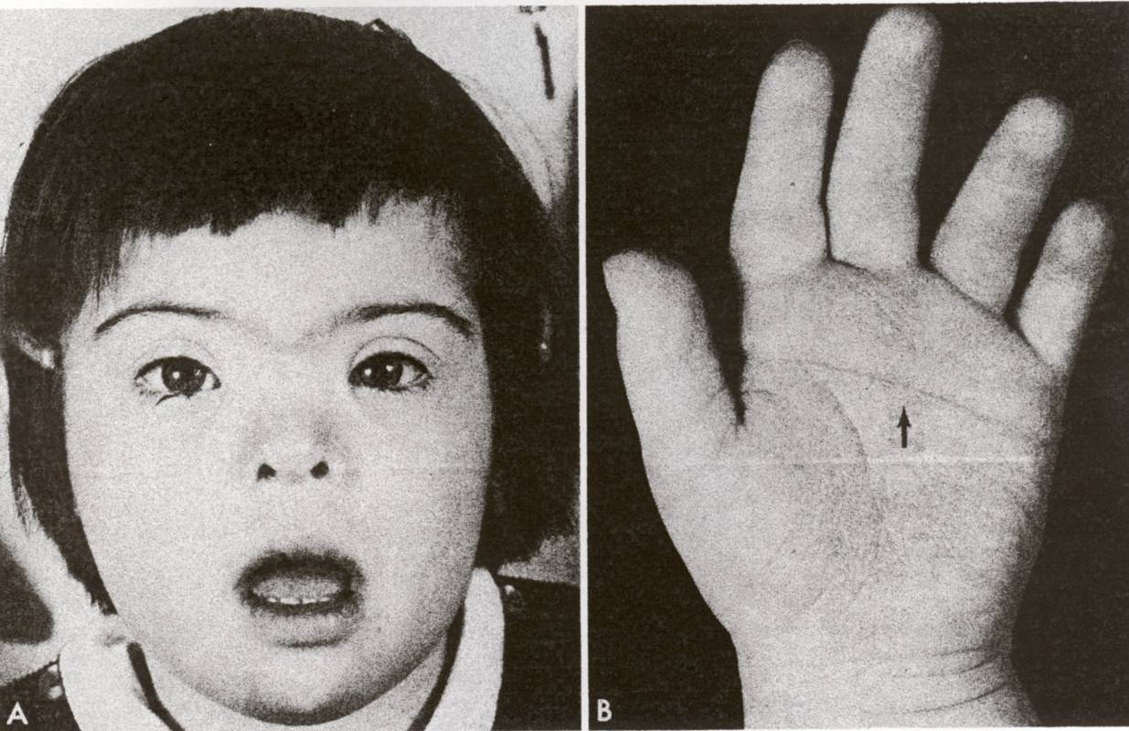 Симптом Рука Нога Рот Фото — Картинки фотографии