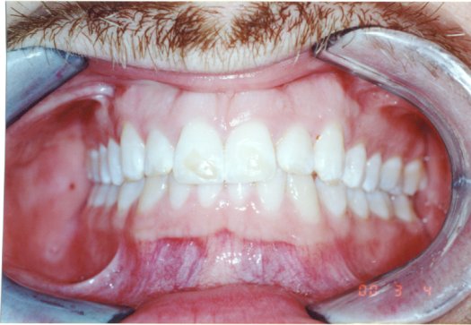 teeth unattractive laminates appear closer patients notice ugly figure