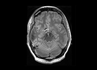Magnetic resonance imaging of a human brain