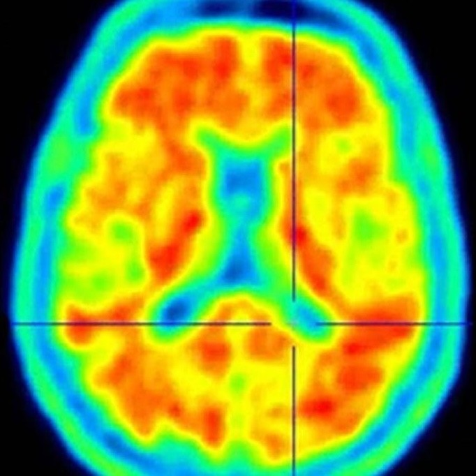 MRI image of a brain