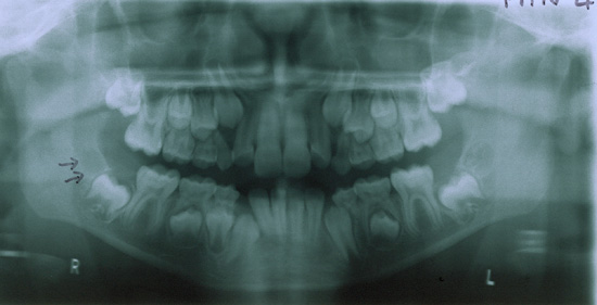 Index of Radiographs